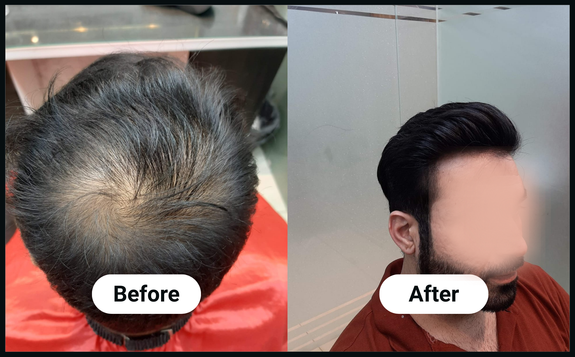 advance-hairline-image (1)