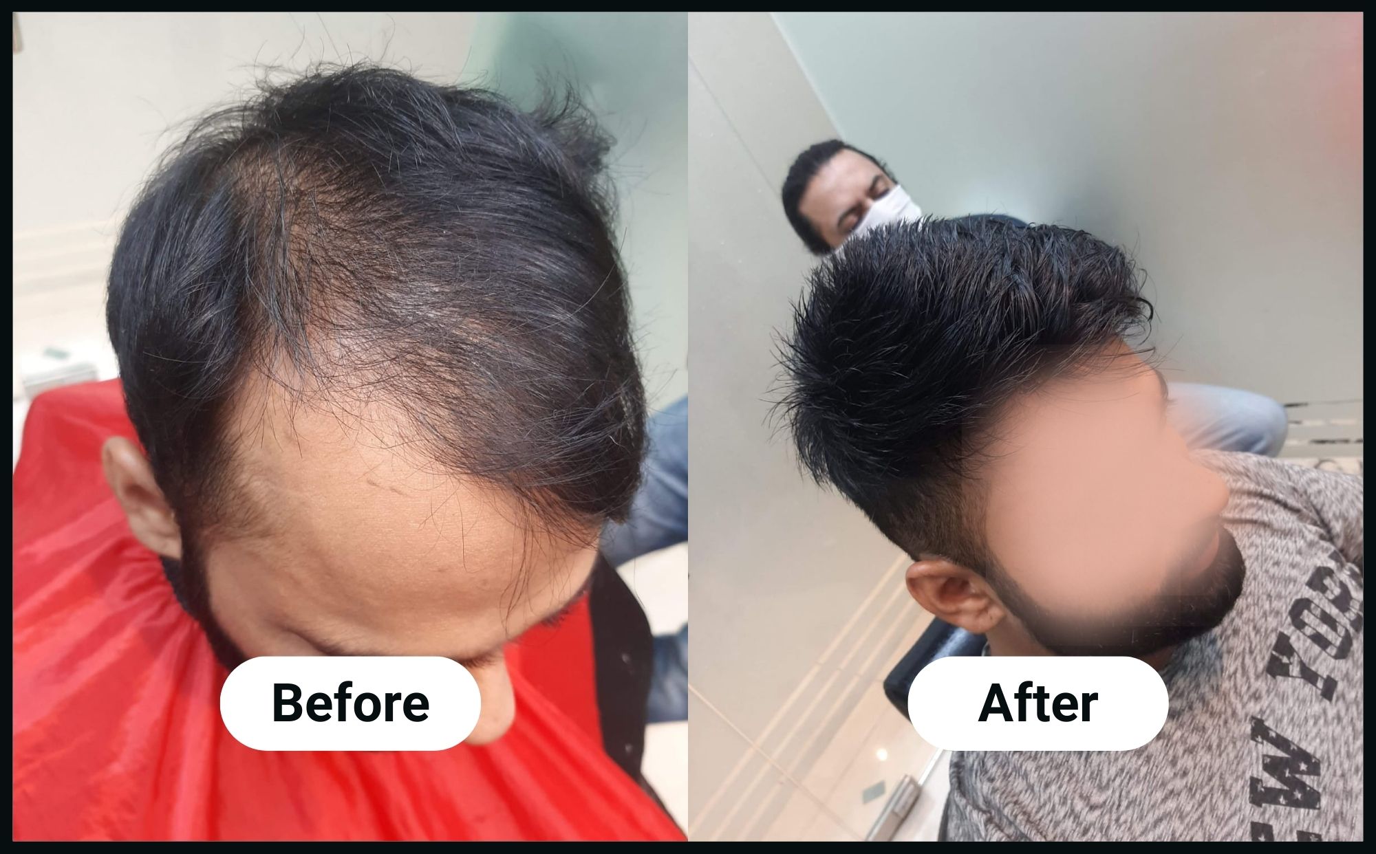 advance-hairline-image